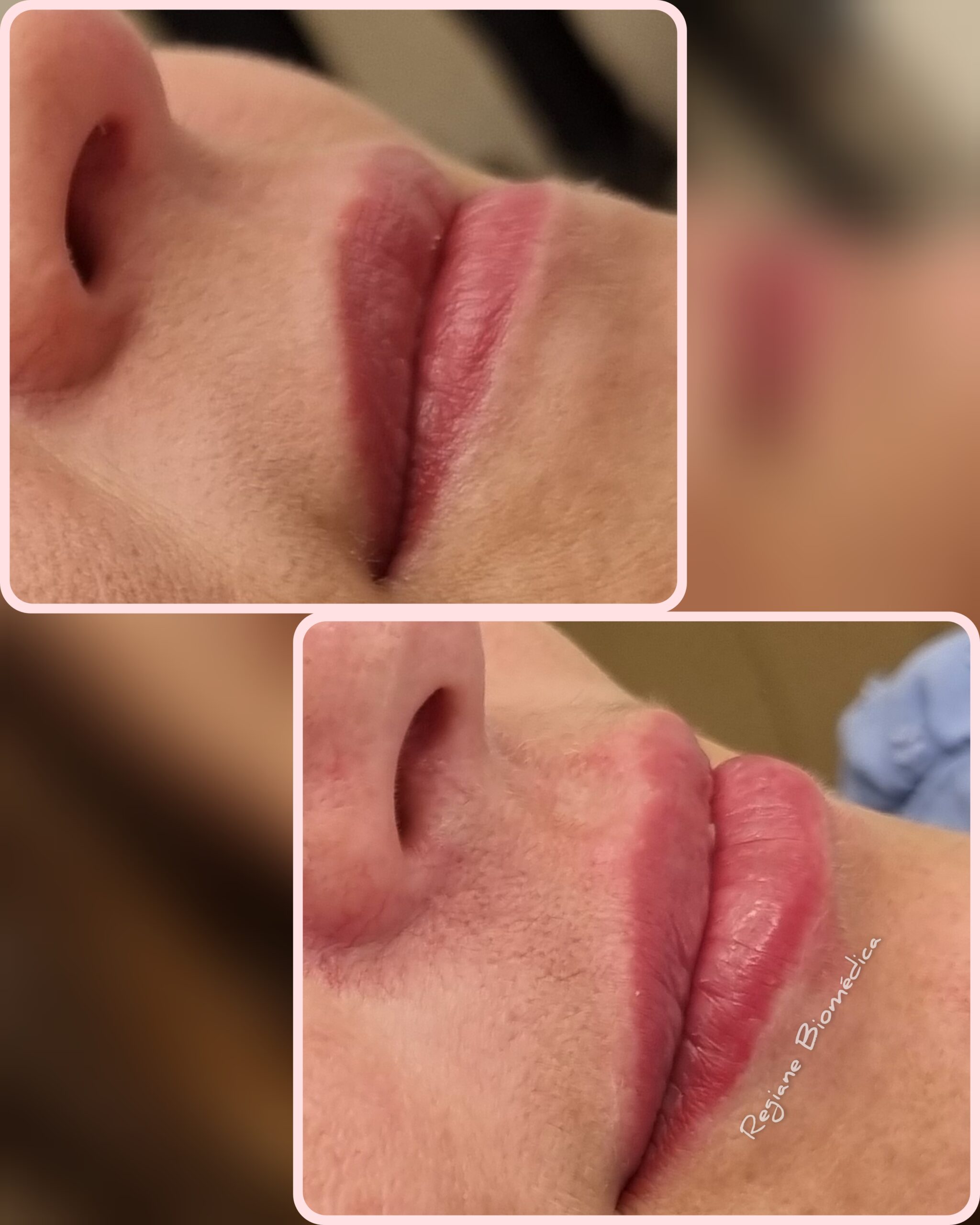 Resultado de tratamento 2