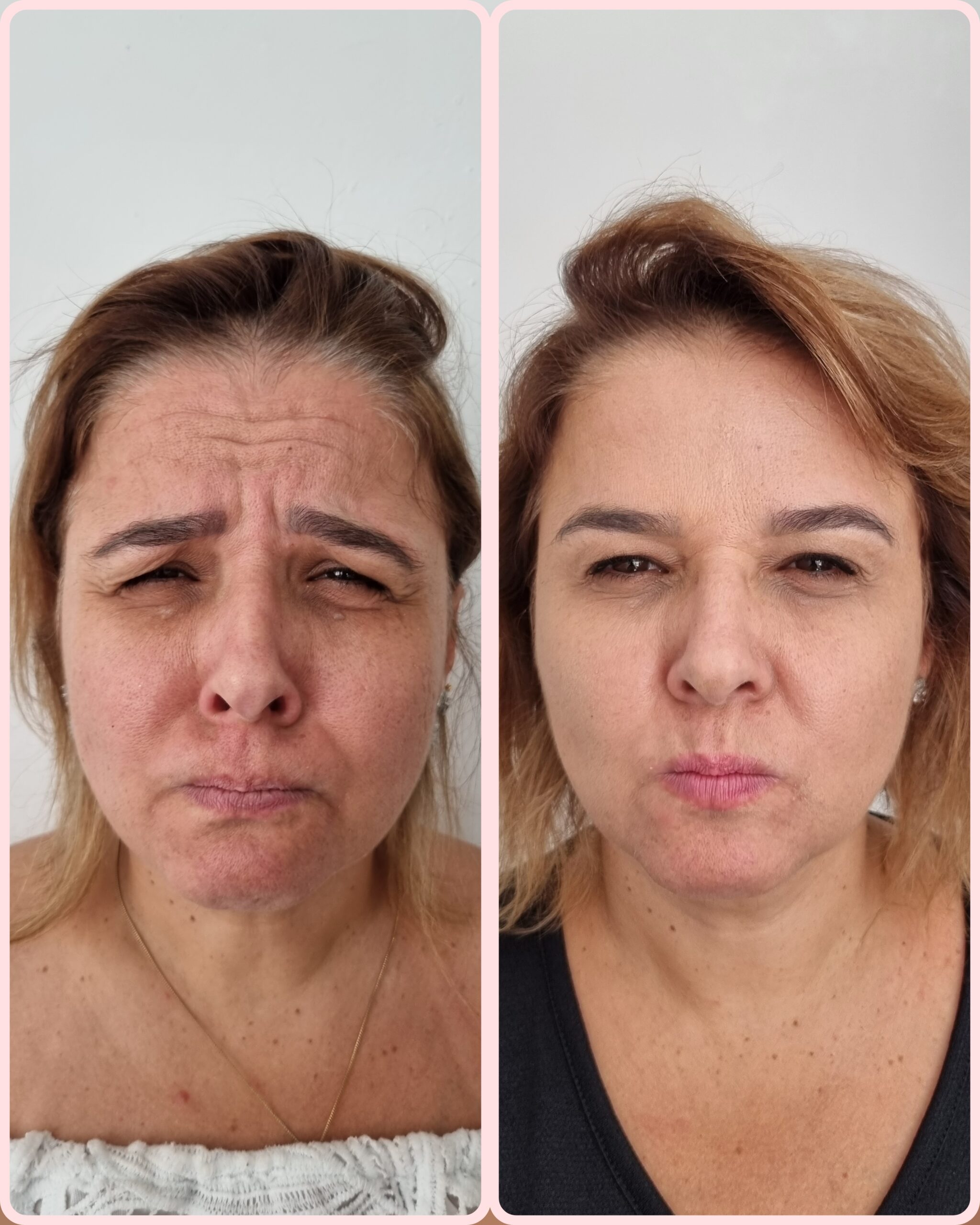 Resultado de tratamento 4